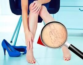 I sintomi dipendono dalla natura e dallo stadio delle vene varicose