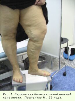 Le vene varicose devono essere trattate per fermare il processo