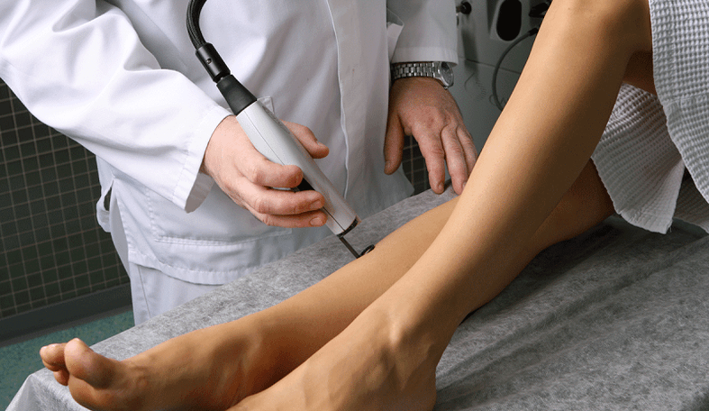 trattamento laser per vene varicose