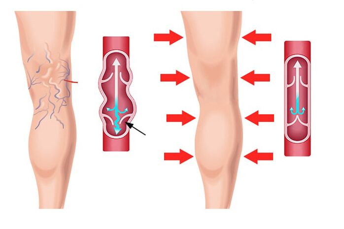 effetto del gel Levicose nel trattamento